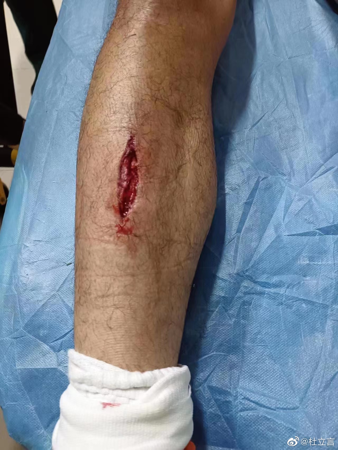 慎点许东被邓涵文铲伤离场腿上一道长长的伤口