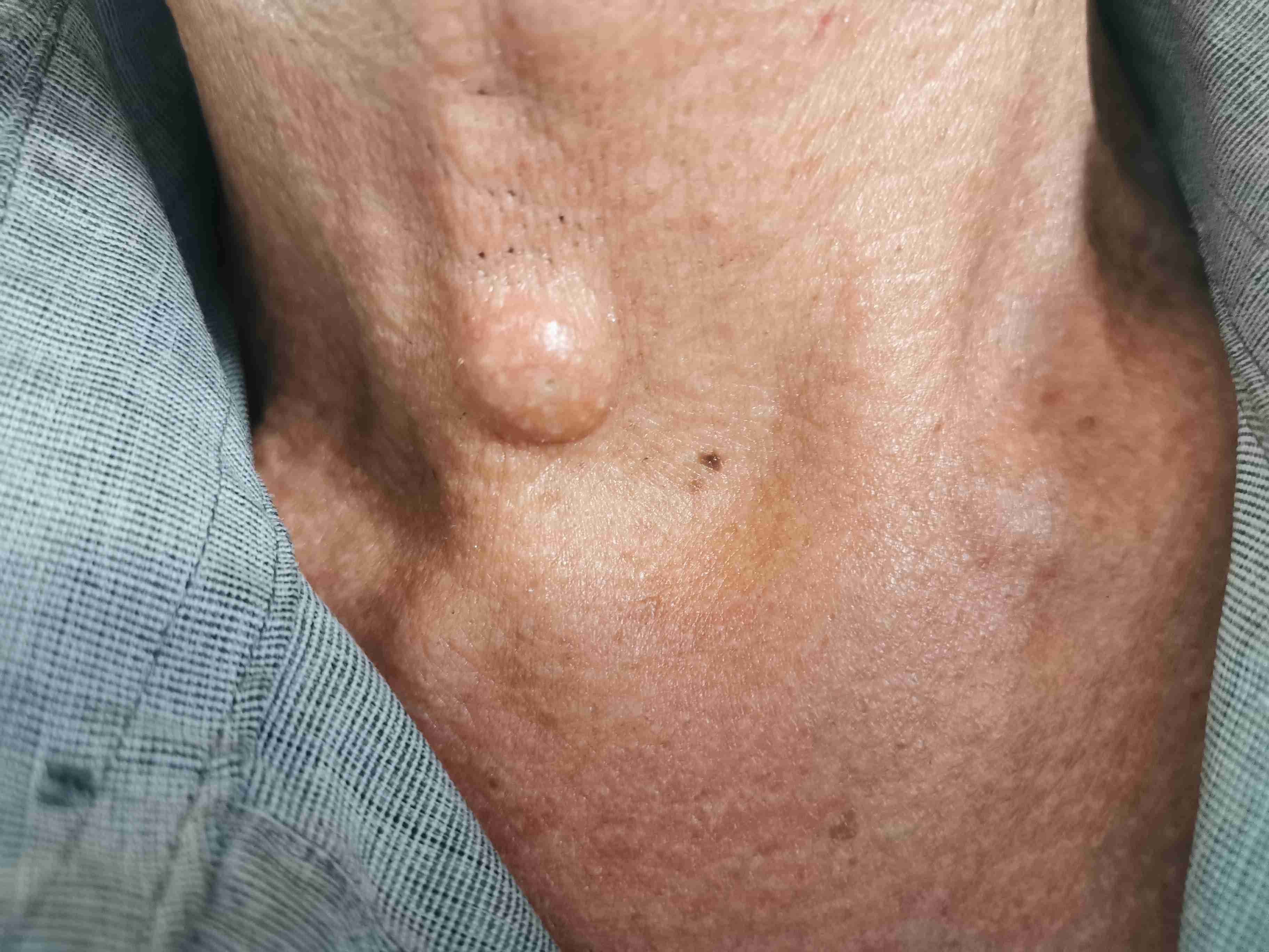 脖子外面长了一个硬硬的疙瘩,但是不痛