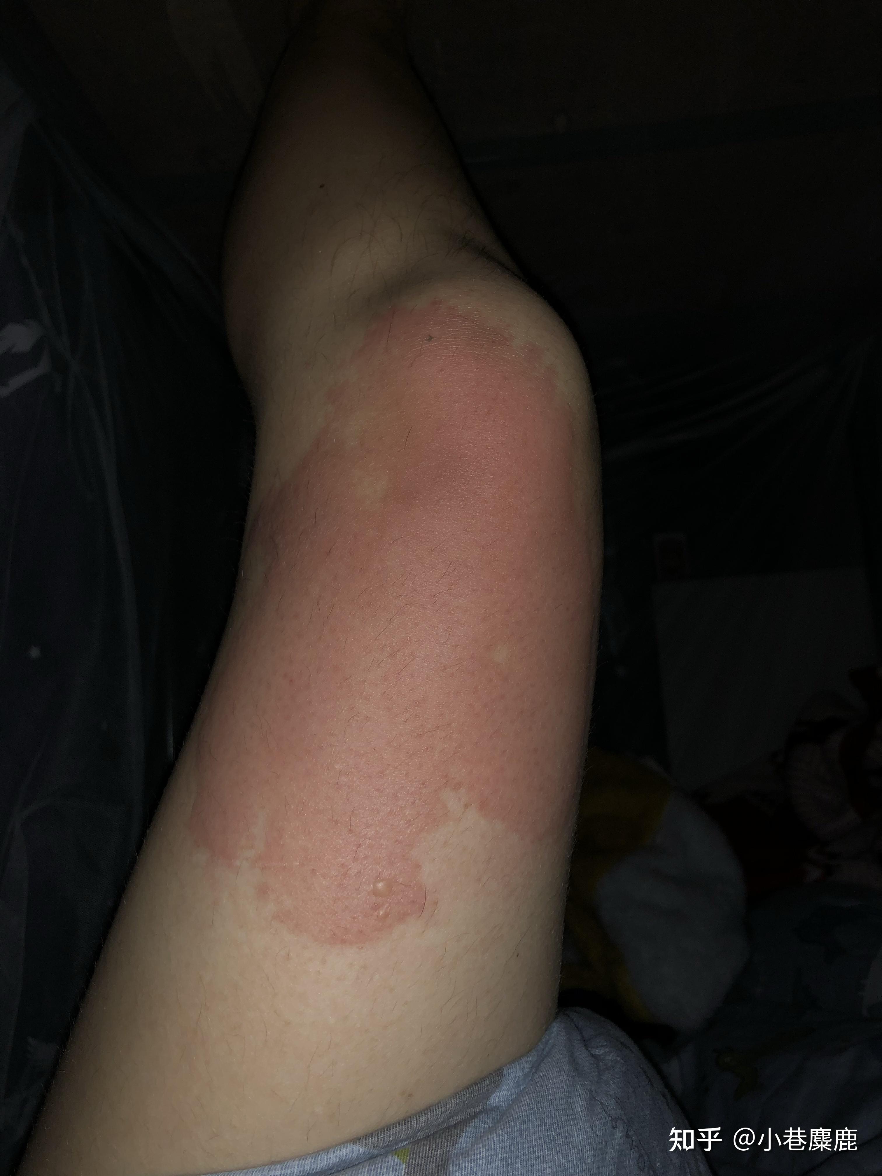 腿部被开水烫伤的恢复记录