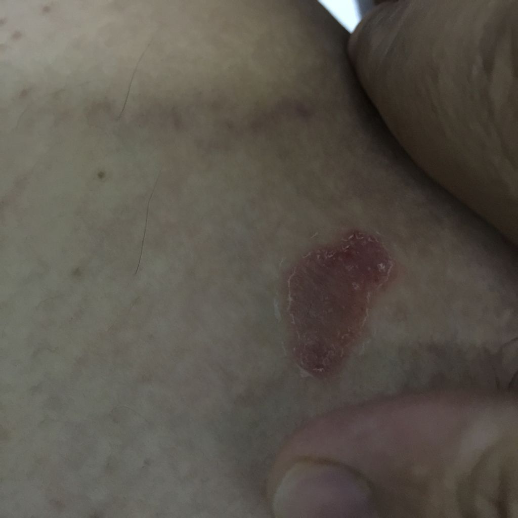 大腿内侧长出一个硬币大小疹,不痛不痒,有10多天了,这个到底啥原因?