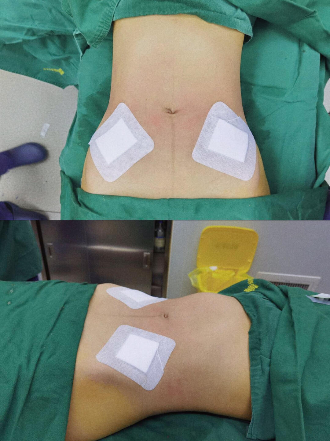 闺蜜产后九个月腰腹环吸78