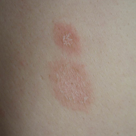 这是什么皮肤病