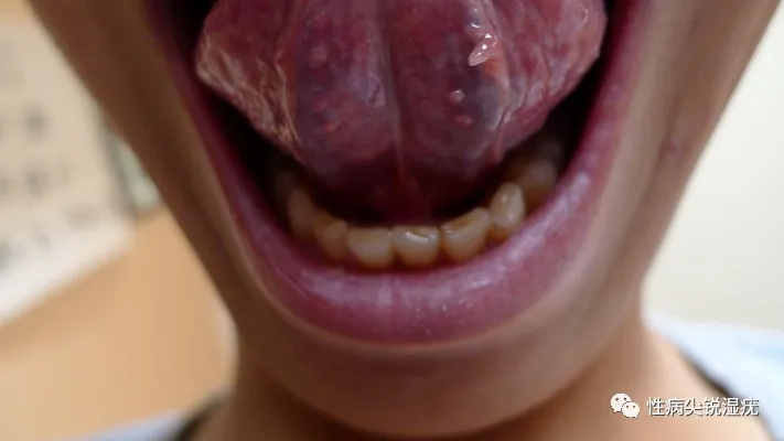 请问这是口腔尖锐湿疣