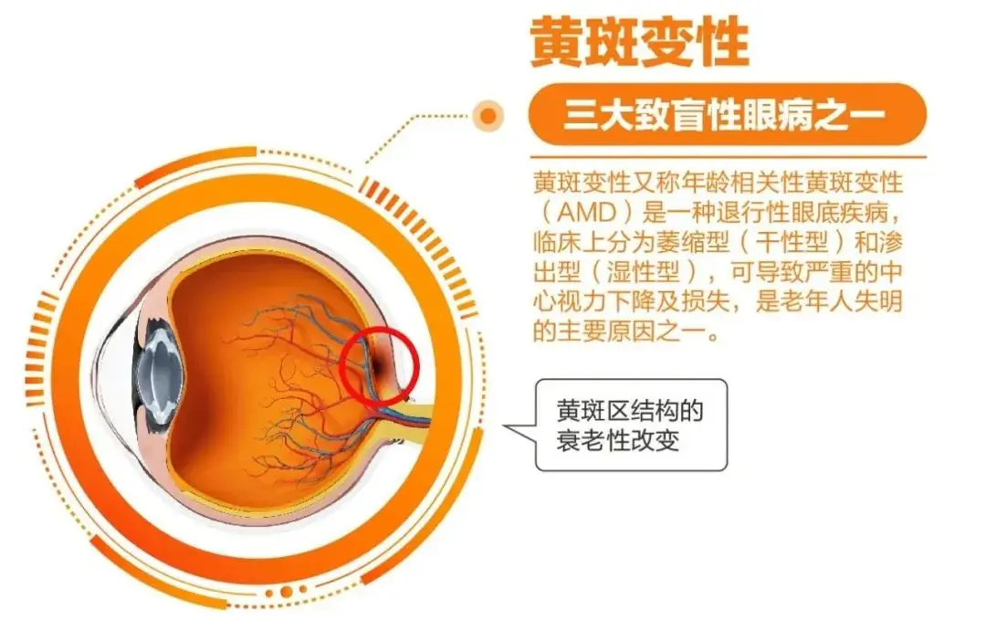 老眼昏花老人要提防视力隐形杀手黄斑变性