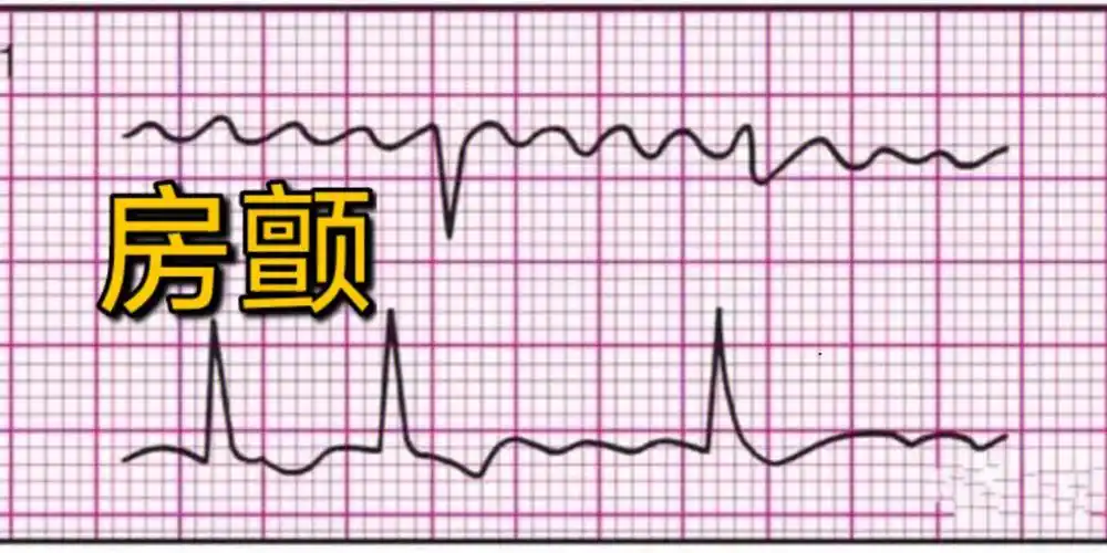 你们都觉得难的心电图