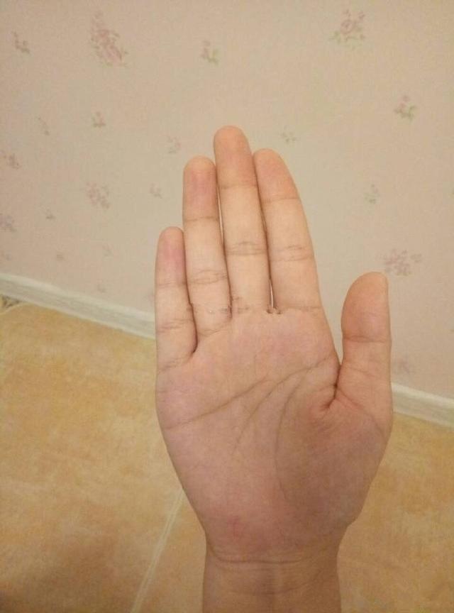 左手掌纹为断掌掌纹,右手接近于断掌,也类似于川字掌纹.