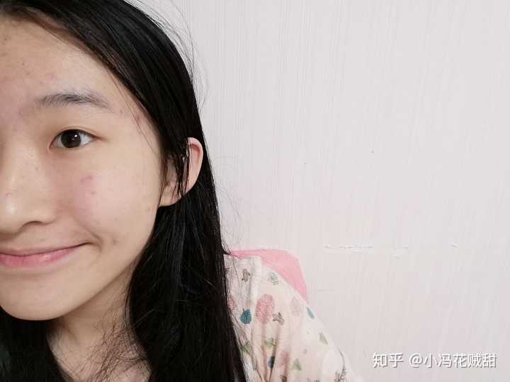 话不多说 放图 左边脸不笑 (忽略痘痘)懒得p掉了 以前只知道脸上窝窝