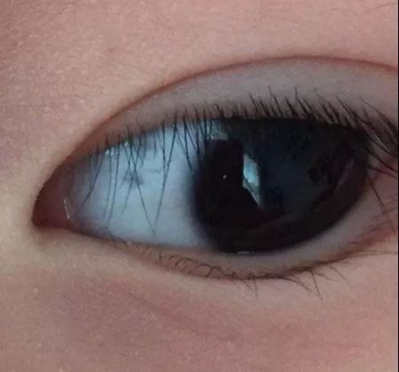 下眼皮发红发青一眼看穿孩子是否长期脾虚